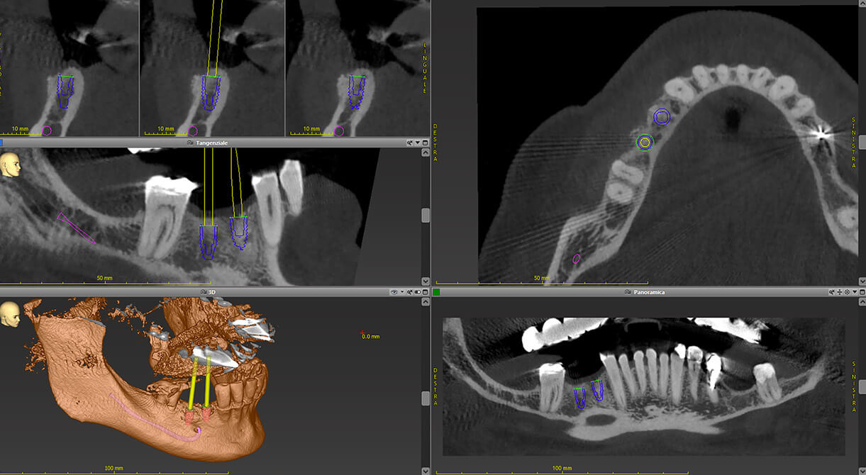 Implantologia dentale. Implantologia dentaria, Implantologia Bologna