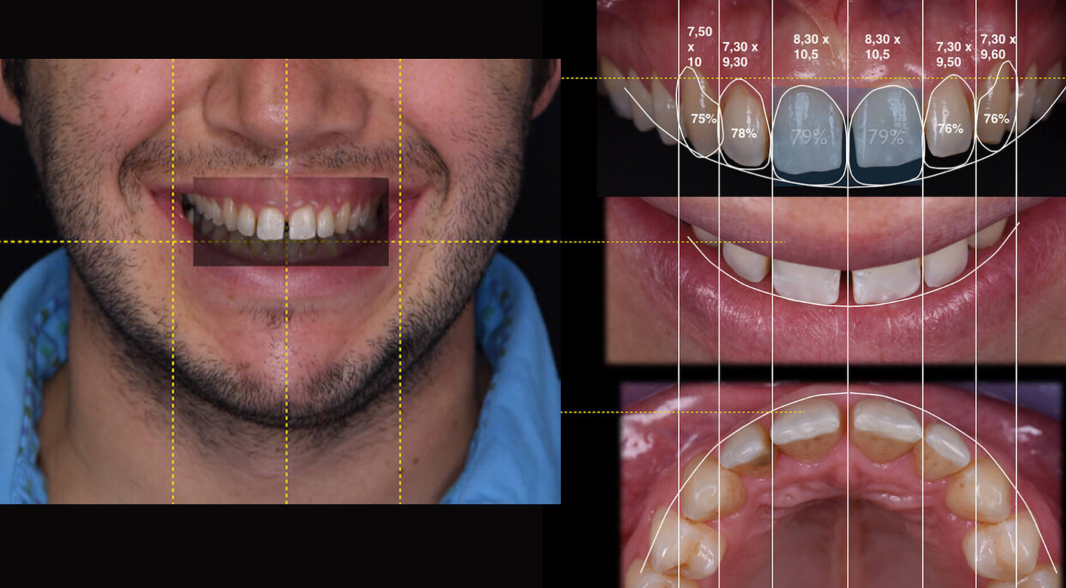 Digital smile design