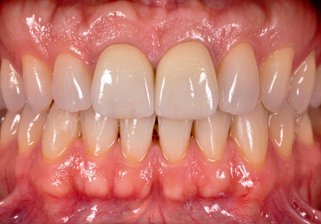 Sorriso paziente post trattamento ortodontico e faccette dentali ceramica