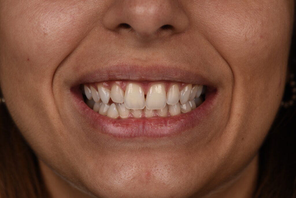 Odontoiatria estetica Bologna - dopo il trattamento di sbiancamento