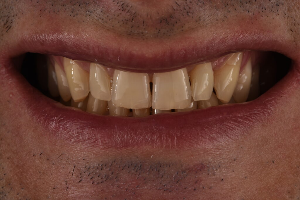 Sbiancamento dei denti: prima del trattamento
