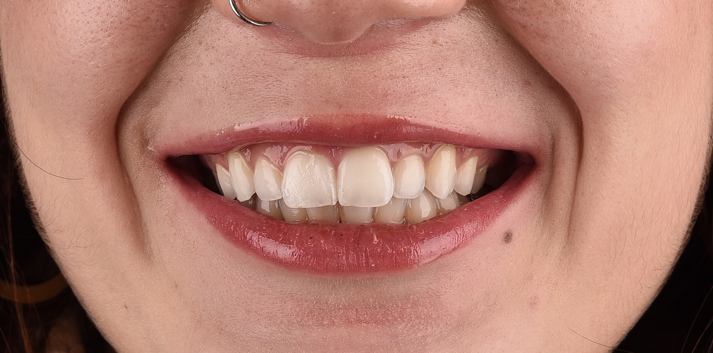 Sbiancamento dei denti: dopo il trattamento