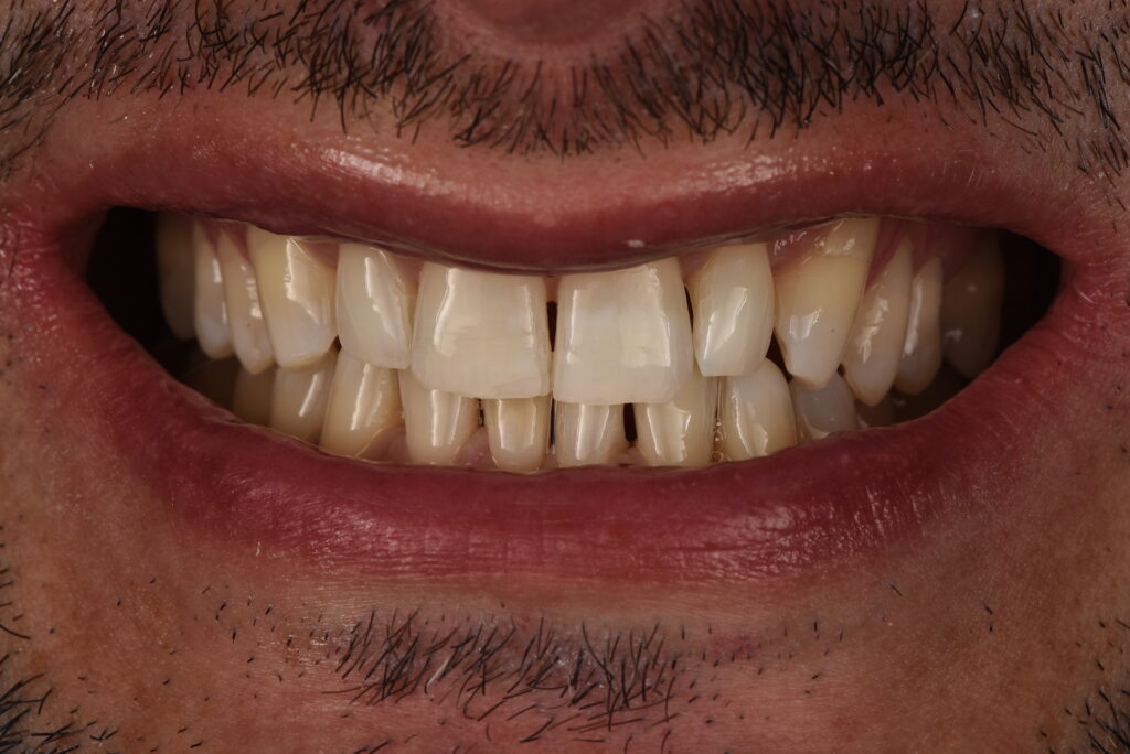 Sbiancamento dei denti: dopo il trattamento