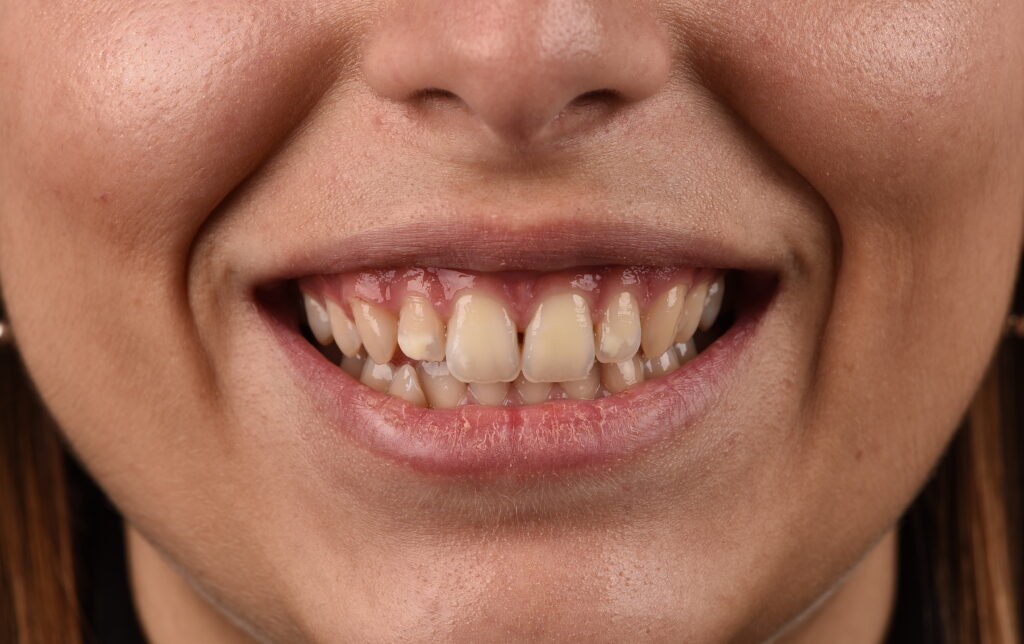 Sbiancamento dei denti: prima del trattamento