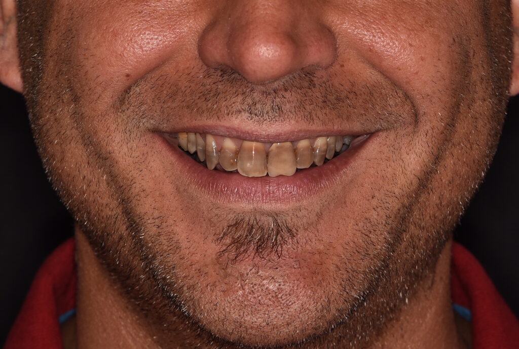 Discromia dentale - prima del trattamento