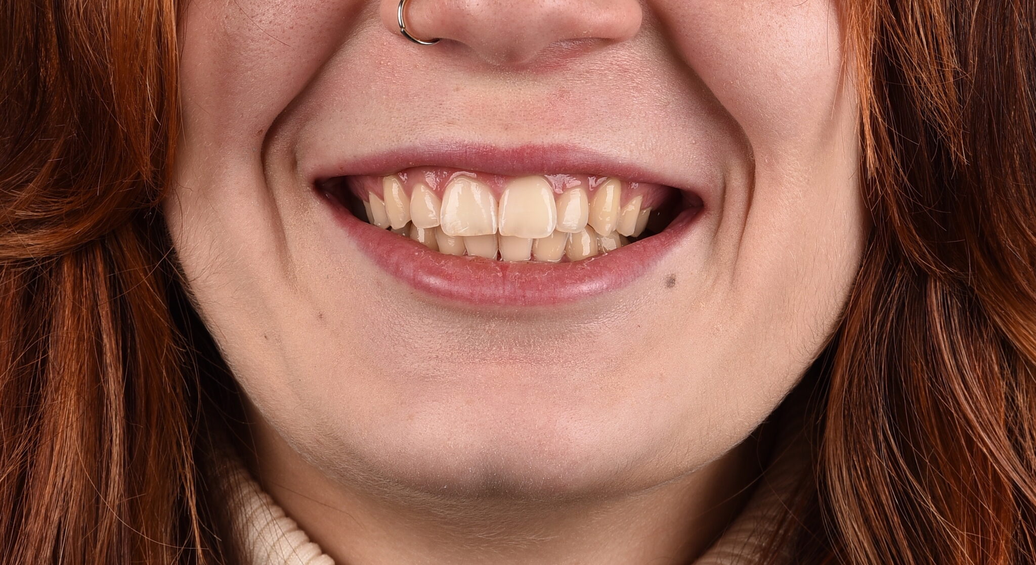 Discromia dentale e sbiancamento - prima del trattamento