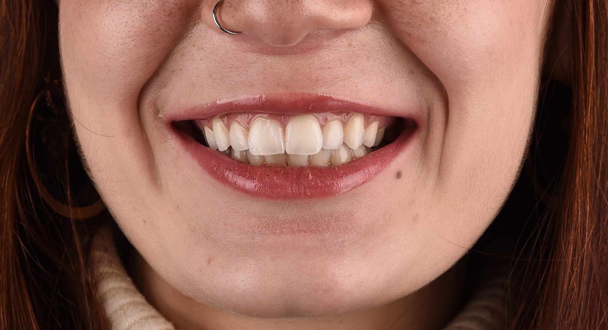 Discromia dentale e sbiancamento - dopo il trattamento