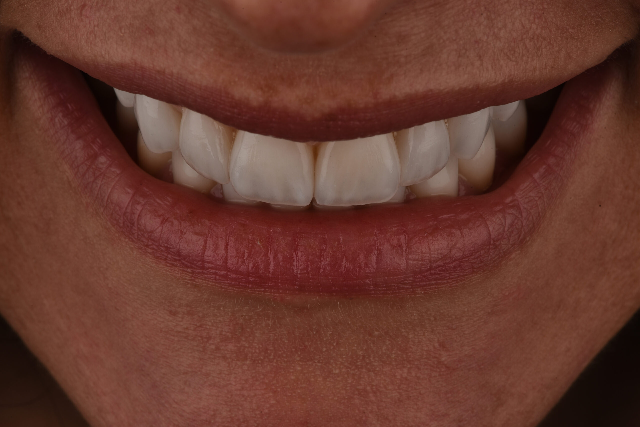 Manutenzione delle Faccette Dentali: Consigli e Raccomandazioni per una Lunga Durata